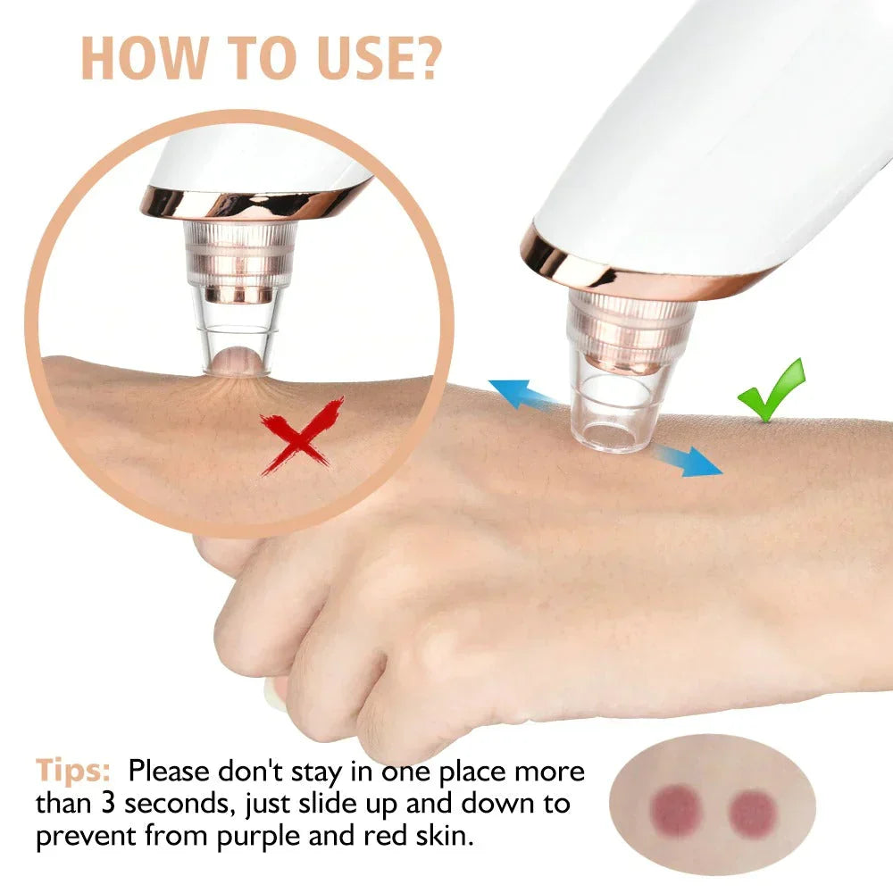 Electric Blackhead Acne Oil Remover Vacuum Suction