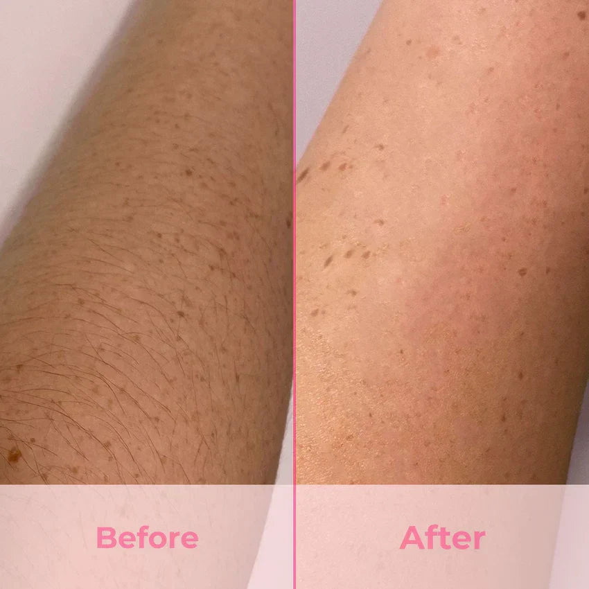 IPL Laser Hair Remover - FDA APPROVED