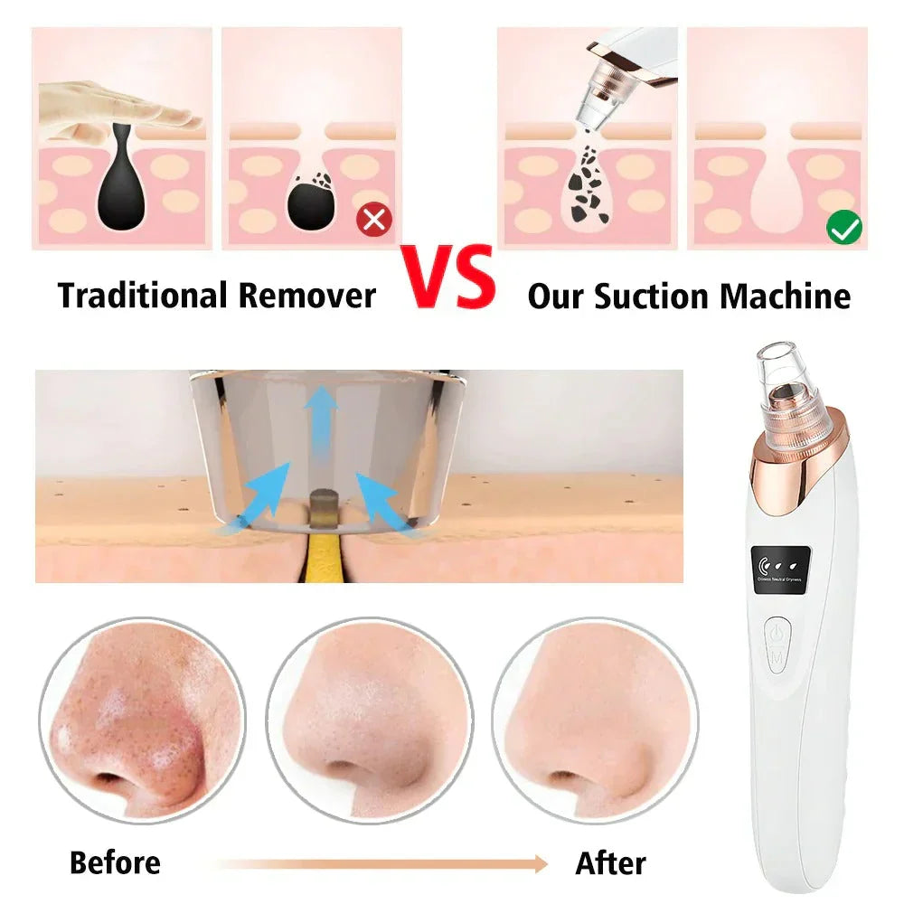 Electric Blackhead Acne Oil Remover Vacuum Suction