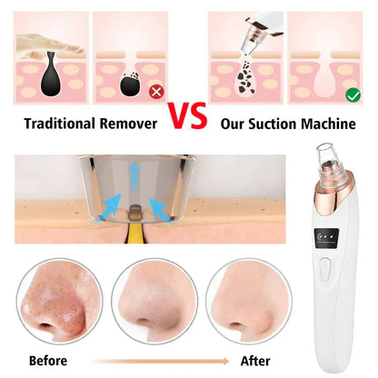 Electric Blackhead Acne Oil Remover Vacuum Suction